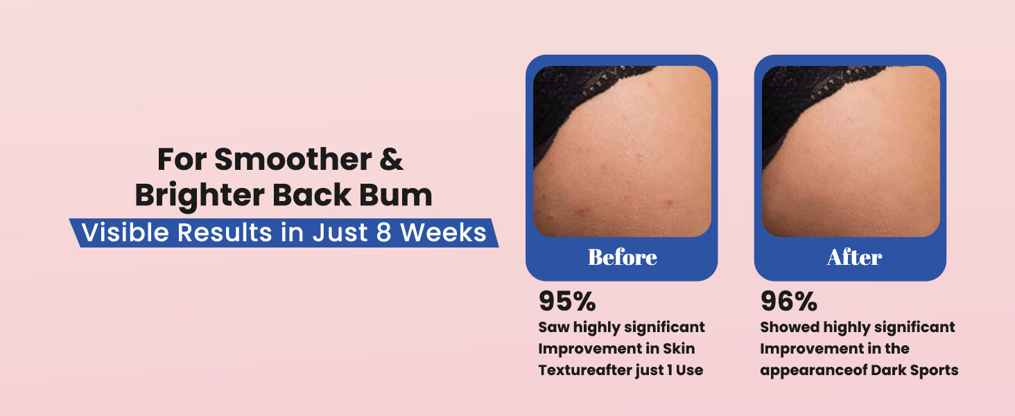 100% Natural Back & Bum Lightening Cream for Men & Women - 50GM
