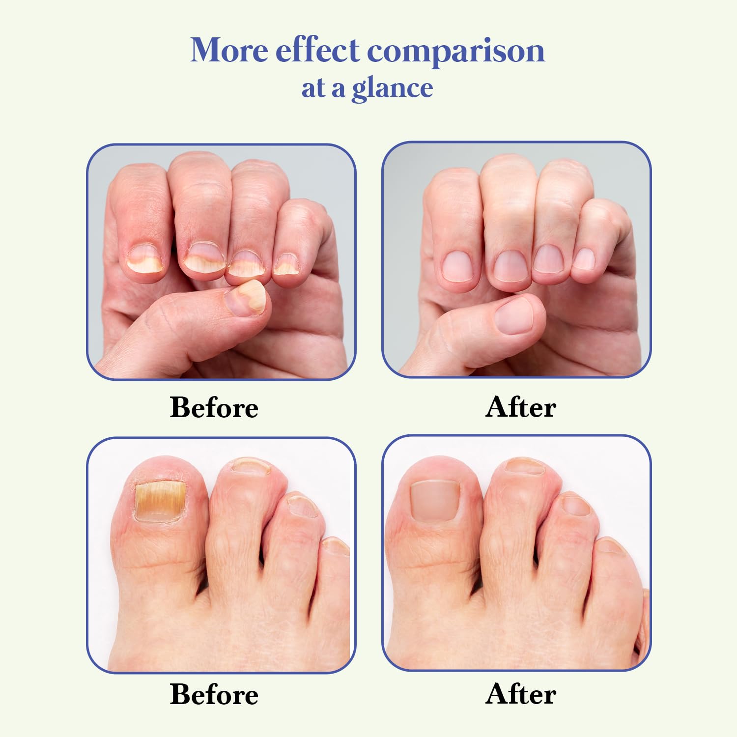 Wipness Nail Repair Serum – Aloe Vera, Vitamin E & Neem Extract