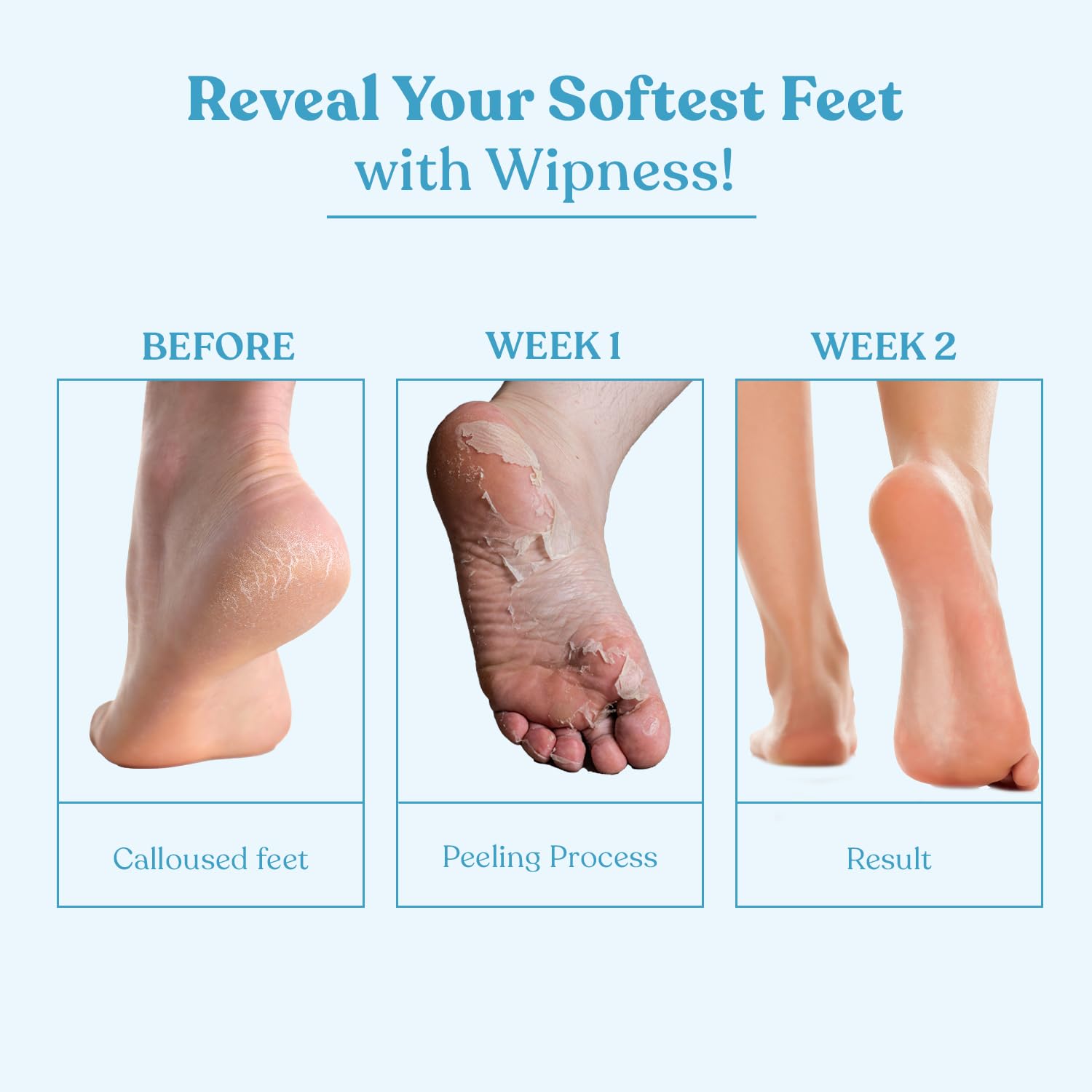Wipness Natural Foot Peeling Mask Baby Soft Feet, Removes Dead Skin & Calluses