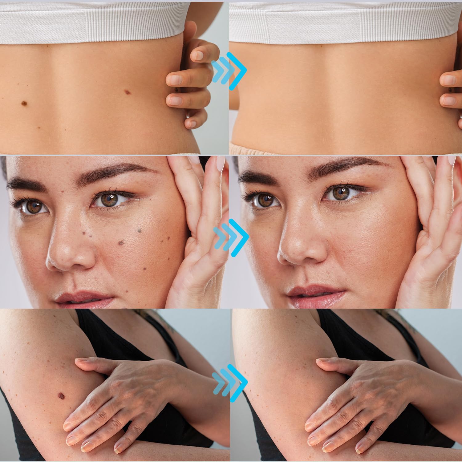 Wipness 100% Natural Wart Remover for Men & Women