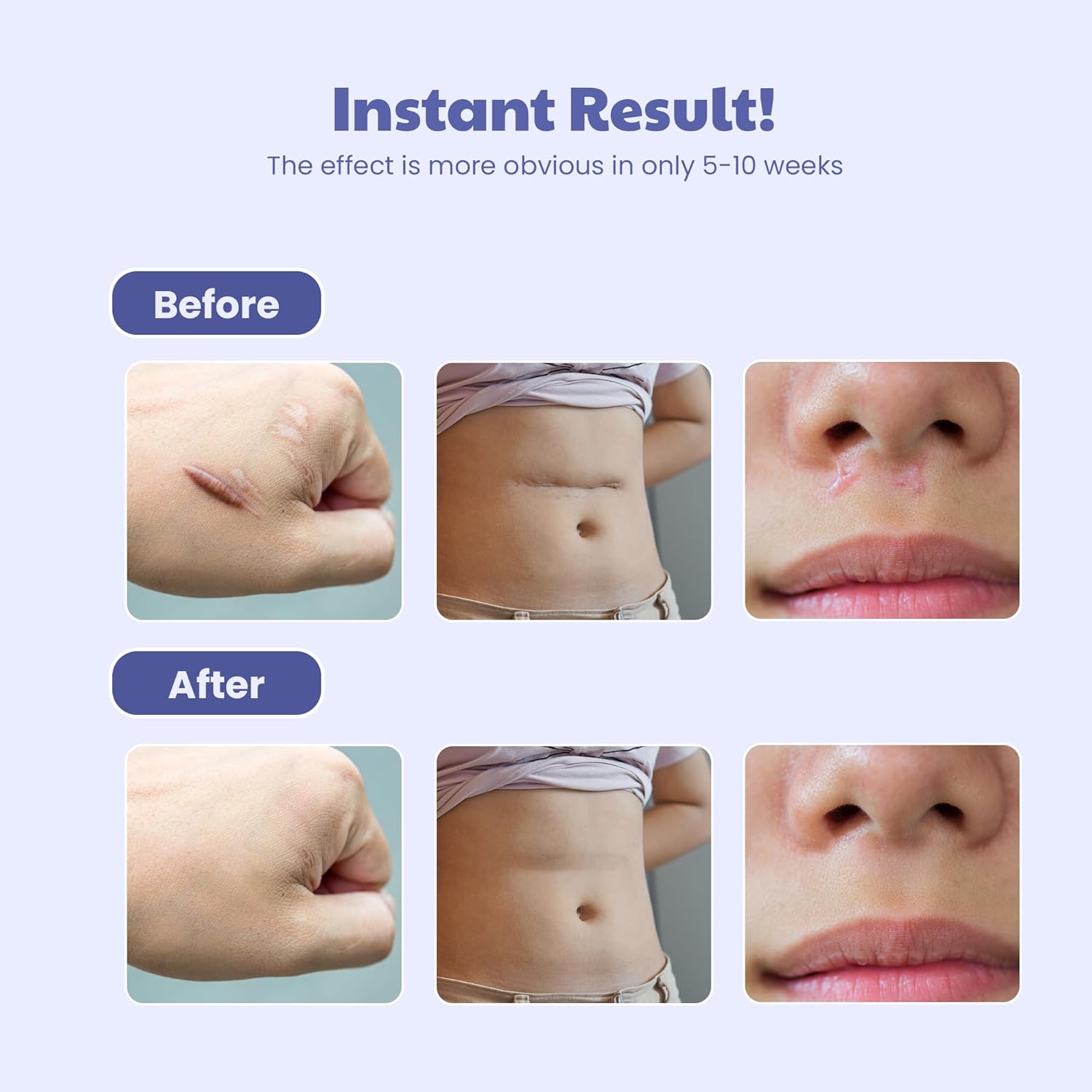 Wipness Medical Silicone Scar Sheets– Surgical & Burn Care 1.6m