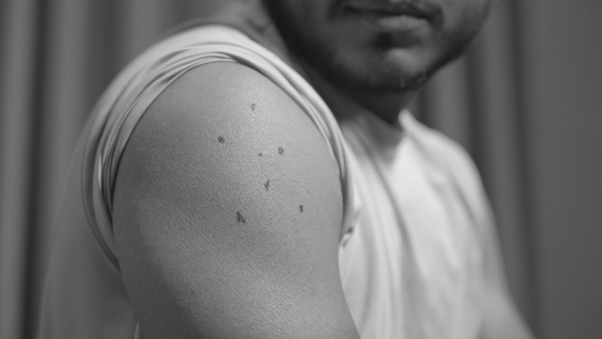 Wipness 100% Natural Wart Remover for Men & Women